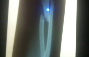 Salimgirey Rasulov X-Ray